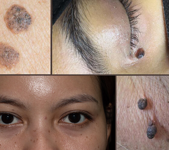 Mole, Warts & Fat Deposit Removal with Natural Herbal Treatment